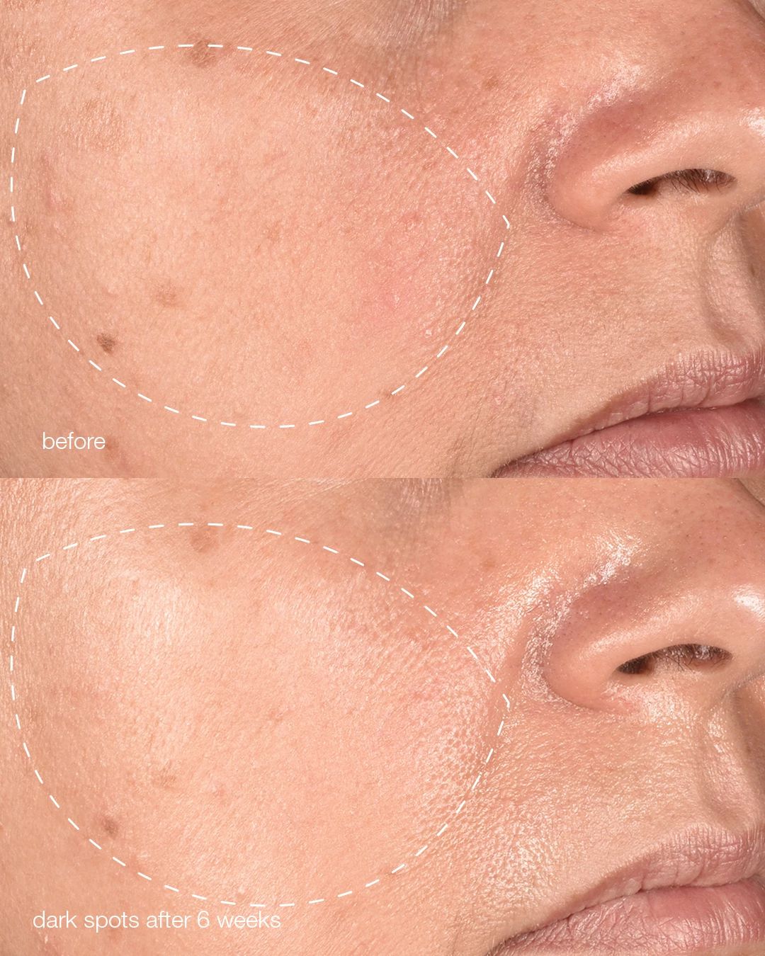 Pro MelanoPro Peeling System 4pk