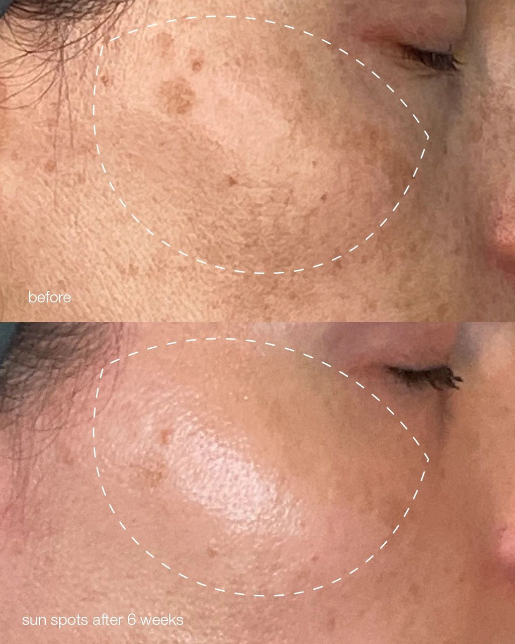 Pro MelanoPro Peeling System 4pk