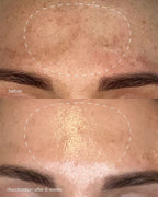 Pro MelanoPro Peeling System 4pk